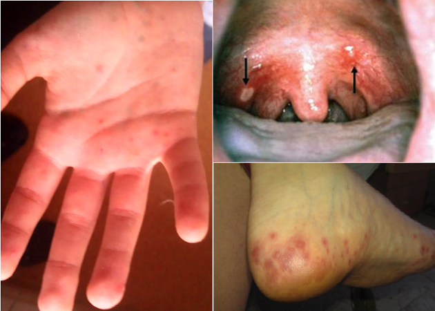 HFMD-Синдром «рука-нога-рот.png